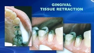 CO2 Dental Laser tissue retraction for crown and bridge impressions [upl. by Illib]