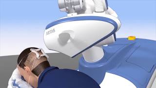 ARTAS Hair Transplant Procedure [upl. by Cone]