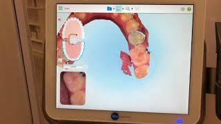 Invisalign Passo a passo [upl. by Baumbaugh]