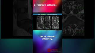 Importance of Interlaminar Space  Dr Pramod Lokhande [upl. by Aveneg288]