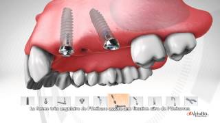 Système de piliers MultiUnit par ALPHABIO TEC [upl. by Yreffej]