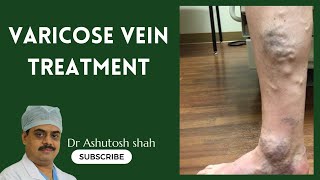 Treatment Procedure of Varicose Veins Ulcer In Best Hospital Elegance Clnic In Surat [upl. by Roth]