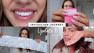 I GOT INVISALIGN WHY HOW LONG FOR ATTACHMENTS  INVISALIGN JOURNEY UPDATE 1 [upl. by Sofia]