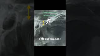 TMJ Subluxation  Radiograph findings  doctor shorts medical surgeon youtubeshorts [upl. by Amle]