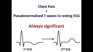 ECG course Pseudonormalization of T waves Dr Sherif Altoukhy [upl. by Johen]