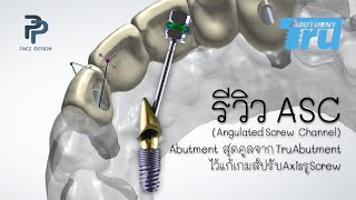 รีวิว ASC Angulated Screw Channel Abutment สุดคูลจาก TruAbutment ไว้แก้เกมส์ปรับAxisรูScrew [upl. by Suired]