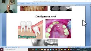 Surgical disorders of tongue and jaw in Arabic 3 Epulis  by Dr Wahdan [upl. by Swann]