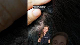 Get Rid Of Scalp Build Up [upl. by Nibor]