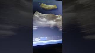 Early pregnancy GS Gastational sac Ovary Ovaries Uterus uterine cavity USG ultrasound PID [upl. by Marcelle]