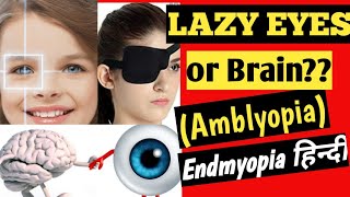 Lazy eye  Amblyopia  Patching  Endmyopia Hindi  कैसे ठीक करे How to treat lazy eye in kids8 [upl. by Hermann602]