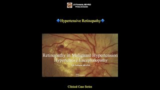 Hypertensive Retinopathy Hypertensive Encephalopathy [upl. by Germayne]