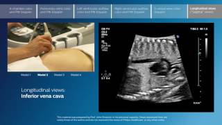 Advanced screening views of the fetal heart  Part 6  Longitudinal views [upl. by Stanley]