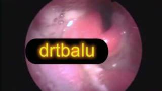 Acute epiglotititis [upl. by Longawa]