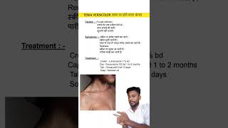 Tenia versicolor  त्वचा पर होने वाला फंगल का treatment [upl. by Trinity393]