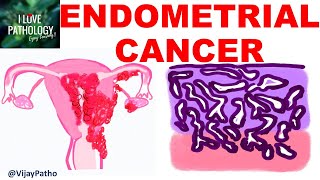 ENDOMETRIAL CARCINOMA Risk factors Etiopathogenesis Morphology amp Clinical features [upl. by Noteloc75]