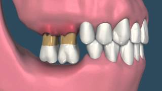 perda de dentes causando extrusão dos dentes antagonistas e reabsorção óssea [upl. by Rodavlas]