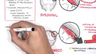 Intracranial Haemorrhage Types signs and symptoms [upl. by Sharla]