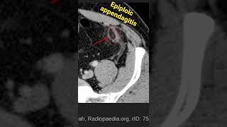 Epiploic appendagitis [upl. by Astrea955]