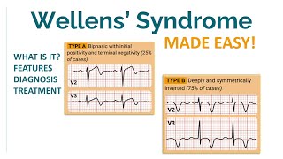 NOTTOMISS condition Wellens syndrome [upl. by Slin]