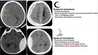 Emergency Neuroradiology Session 1 Spontaneous ICH amp Brain Aneurysms [upl. by Fritze]