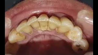 Limpeza dos Dentes com Ultrassom – Remoção de Cálculo Dental [upl. by Arymas]