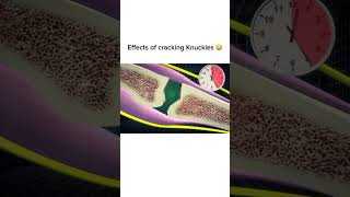 Effects of Cracking Knuckles [upl. by Palmer]