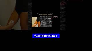 Identifying the Great Saphenous Vein vascularultrasound healthcareexcellence MedicalEducation [upl. by Yeldarb]