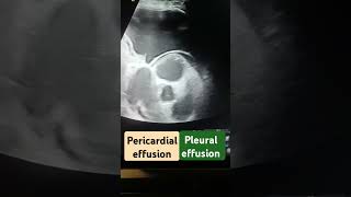 ultrasonography radiological radiology heart effusion phonk halloween beats typebeat [upl. by Narhet]