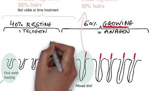 Electrolysis hair removal regrowth time between session and total duration [upl. by Jacklin]