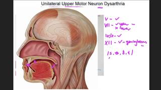 Unilateral Upper Motor Neuron Dysarthria  example and tutorial [upl. by Swehttam720]