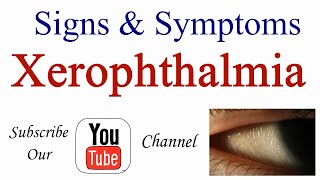 Signs and Symptoms of Xerophthalmia [upl. by Kamal]