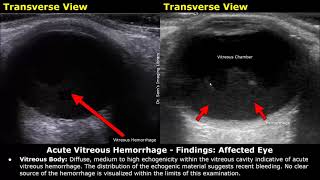 Eye Ultrasound Reporting  Cataract Retinal Detachments Vitreous Hemorrhage USG Case Reports [upl. by Liagibba]