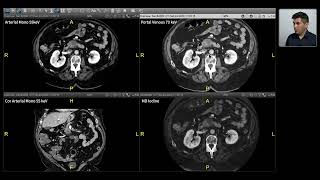 Spectral Imaging  Pancreas [upl. by Kendra]