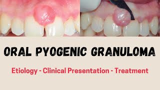 ORAL PYOGENIC GRANULOMA Etiology  Clinical Presentation  Treatment [upl. by Carlotta]