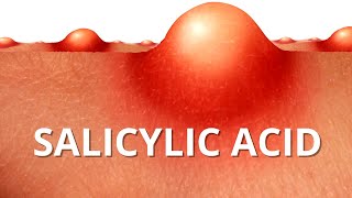 Heres WHY Salicylic Acid is Best For ACNE [upl. by Nahc622]