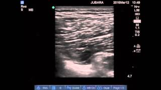 sciatic nerve blockposterior cutaneous nerve of the thigh block [upl. by Snook]