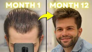 How I Regrew My Hair Using 3 Proven Treatments MonthbyMonth Results [upl. by Teak]