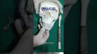 Guided Mandible Resection amp Reconstruction using Fibula Free Flap amp CustomMade Titanium Implant [upl. by Rimhsak390]