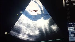 IVC ultrasound [upl. by Atteuqal975]