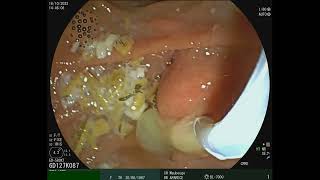 Choledocholithiasis amp Suppurative cholangitis [upl. by Eelrebma]