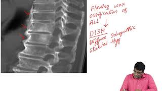 Ankylosing Spondylitis Vs DISH [upl. by Hew]