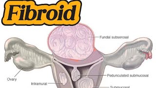 Uterine Fibroid  Mass Uterus  DUB on ultrasound [upl. by Mcginnis467]