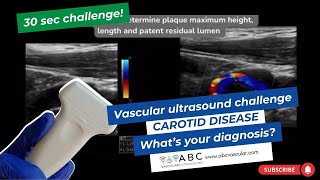 30 SECONDS VASCULAR ULTRASOUND CHALLENGE CAROTID DISEASE SEE DESCRIPTION FOR FULL CASE EXPLANATION [upl. by Iliram672]