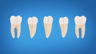 Understanding Cracked Tooth Treatment and Symptoms [upl. by Ailee527]