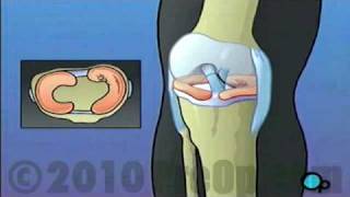 Anterior Cruciate Ligament Arthroscopic Repair PreOp® Patient Education [upl. by Aivle768]