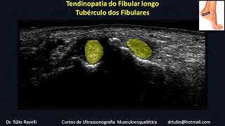 Ultrassom do Tornozelo  Tubérculo do Fibulares e Tendinopatia do Fibular longo [upl. by Gorey528]