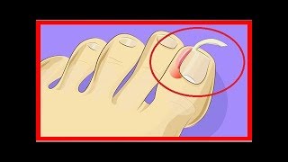 Voici comment guérir un ongle incarné sans avoir besoin de chirurgie [upl. by Quintina423]