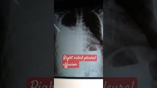 Pleural effusion  right [upl. by Kathlene375]