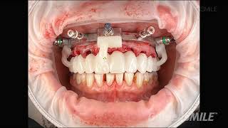 GuidedSMILE Dentate Natural Single Maxillary  Dr Agahi [upl. by Murvyn]