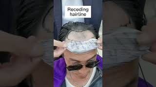 Hair Patches  Revolutionary Solution to Your Receding Hairline LaVivid Hair [upl. by Gosselin]